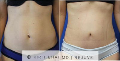 Diastasis Recti Repair before and after photo