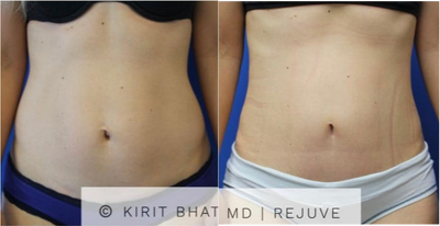 Diastasis Recti Repair before and after photo