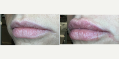 Juvederm before and after photo