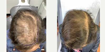 PRP Injections before and after photo