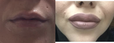 Restylane before and after photo