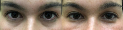 Restylane before and after photo