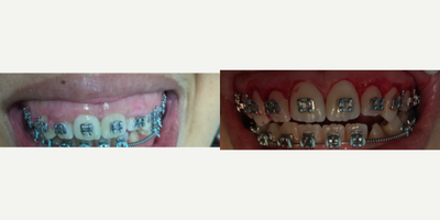 Gum Lift before and after photo