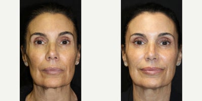 before and after image