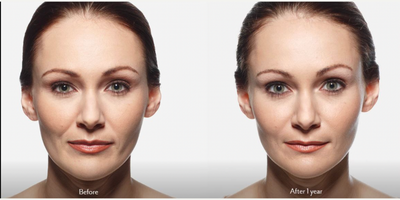 Juvederm before and after photo