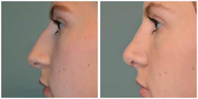 Rhinoplasty before and after photo