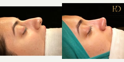 Rhinoplasty before and after photo