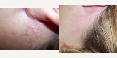 Sclerotherapy before and after photo