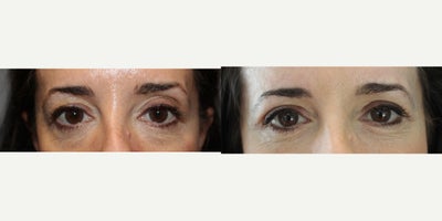 Eyelid Surgery before and after photo