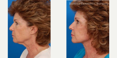 Facelift before and after photo