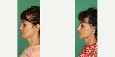 Facelift before and after photo