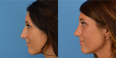 Rhinoplasty before and after photo