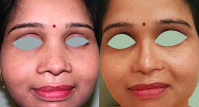 Asian Rhinoplasty before and after photo