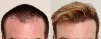 FUE Hair Transplant before and after photo