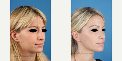 Rhinoplasty before and after photo