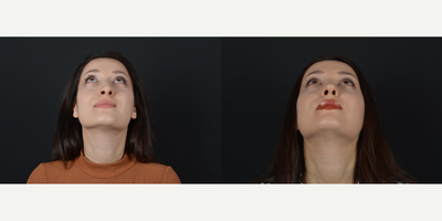 Rhinoplasty before and after photo