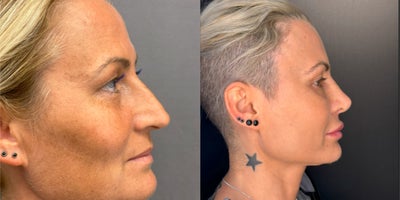 Brow Lift before and after photo