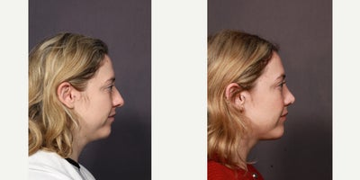 Chin Implant before and after photo