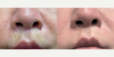 CO2 Laser before and after photo