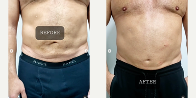 Liposculpture before and after photo