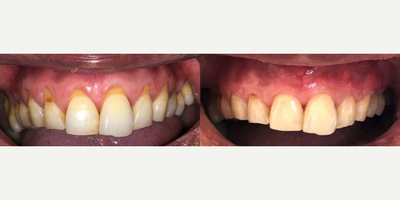 Pinhole Gum Surgery before and after photo
