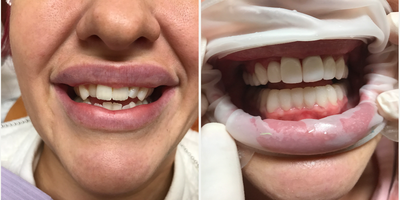 Porcelain Veneers before and after photo
