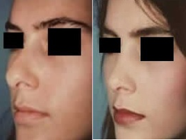 Rhinoplasty before and after photo