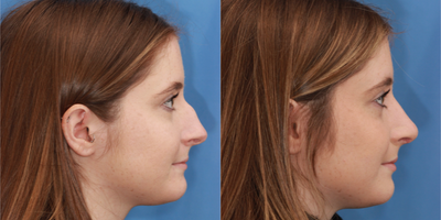Rhinoplasty before and after photo