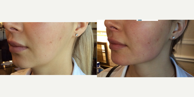 Dermal Fillers before and after photo