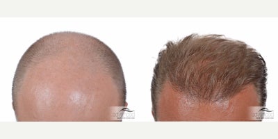 Hair Transplant before and after photo