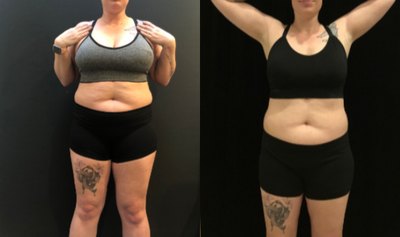 Obalon Intragastric Balloon before and after photo