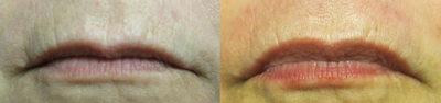 Pelleve before and after photo