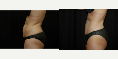Tummy Tuck before and after photo