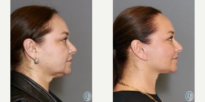 Buccal Fat Removal before and after photo