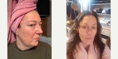 Chemical Peel before and after photo