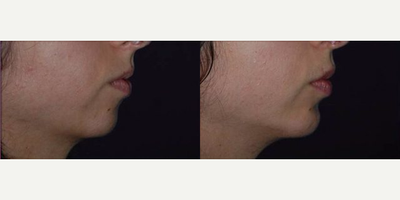 Chin Implant before and after photo