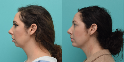 Chin Implant before and after photo
