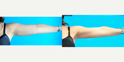 CoolSculpting before and after photo