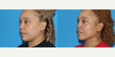 Eyelid Surgery before and after photo
