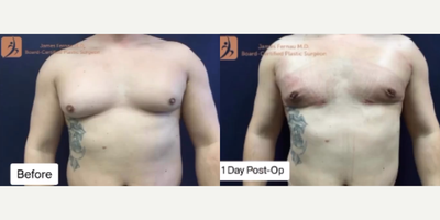 Liposuction before and after photo