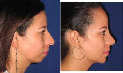 Rhinoplasty before and after photo