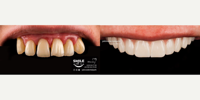Dental Implants before and after photo