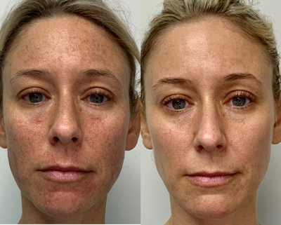 IPL before and after photo