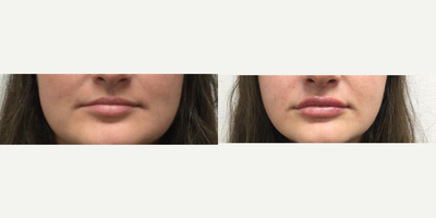 Juvederm before and after photo
