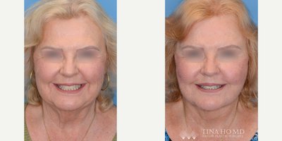 Facelift before and after photo