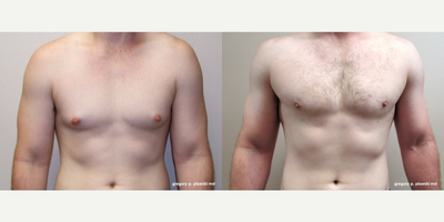 Gynecomastia Surgery before and after photo
