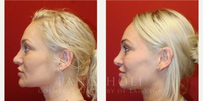 Revision Rhinoplasty before and after photo