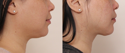 Buccal Fat Removal before and after photo