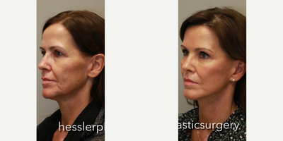 Cheek Augmentation before and after photo