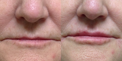 Facial before and after photo